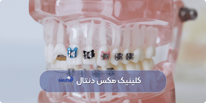 بدترین رنگ نگین ارتودنسی دخترانه چه رنگی است
