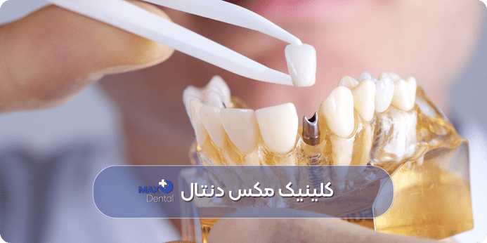 ایمپلنت دندان، بهترین جایگزین برای دندان کشیده شده