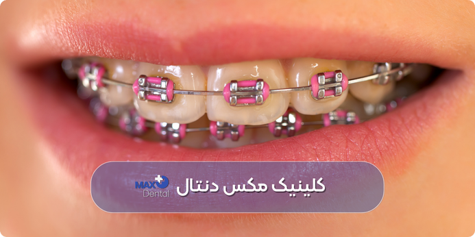 بهترین رنگ ارتودنسی دخترانه، صورتی