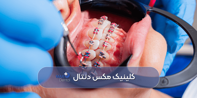 دریافت مشاوره یکی از مهم ترین اقدامات قبل از ارتودنسی دندان