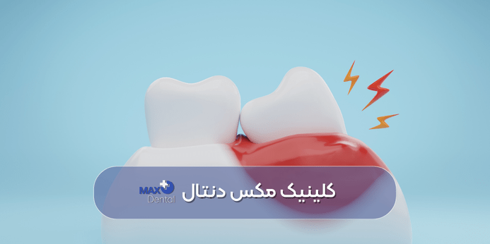 درمان بیماری لثه