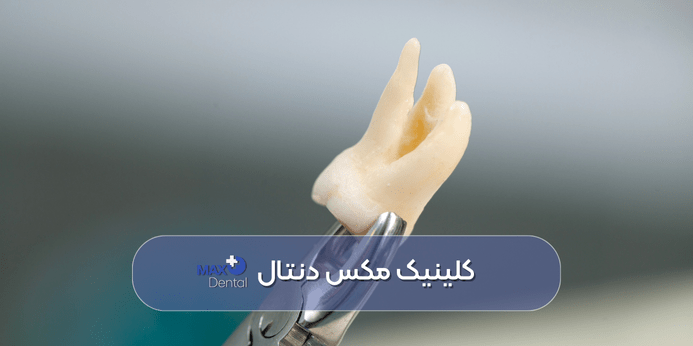 کشیدن دندان قبل از ارتودنسی