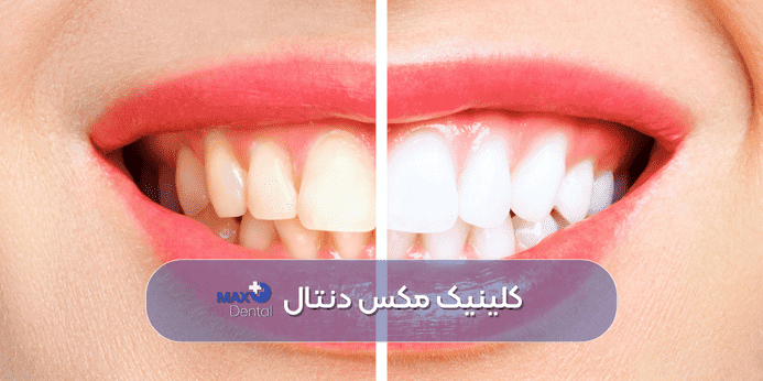 بلیچینگ قبل از ارتودنسی