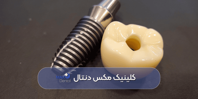 مزایا و معایب ایمپلنت فوری چیست
