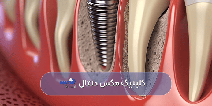 شرایط ایمپلنت دندان قبل از انجام آن چیست