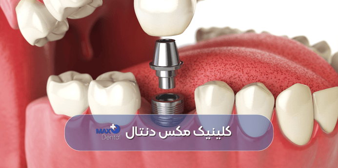 مراقبت های بعد از کاشت ایمپلنت دندان