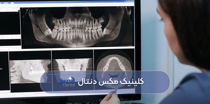 مراحل انجام ایمپلنت یک روزه چیست