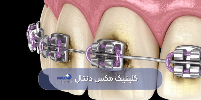 نکات مهم پوسیدگی دندان در ارتودنسی