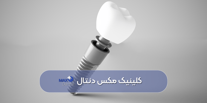 عوامل موثر بر قیمت ایمپلنت فوری چیست