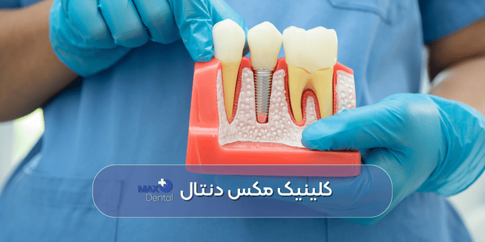 بهترین شرایط کاشت ایمپلنت دندان