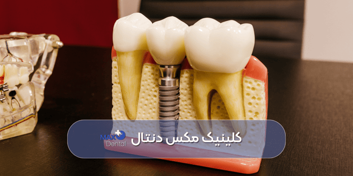 بررسی شرایط پزشکی کاشت ایمپلنت