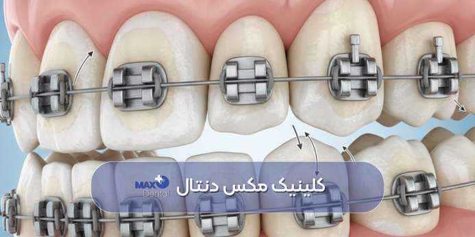 روش های پیشگیری از پوسیدگی دندان در ارتودنسی